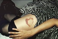 Heart-shaped Bruise, NYC, 1980