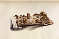 ‘Tubercular leprosy’ (or ichthyosis) of the hand