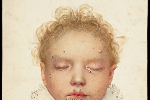 The head of a child with blisters and other lesions affectin