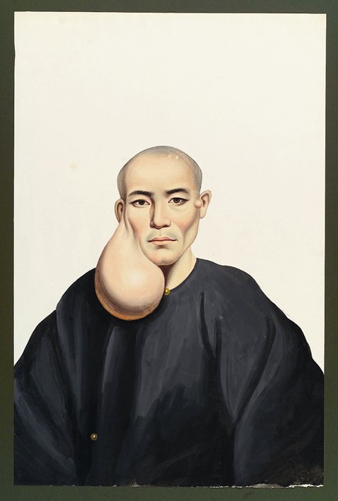 A man with a large pendent face tumour in gouache by the pai