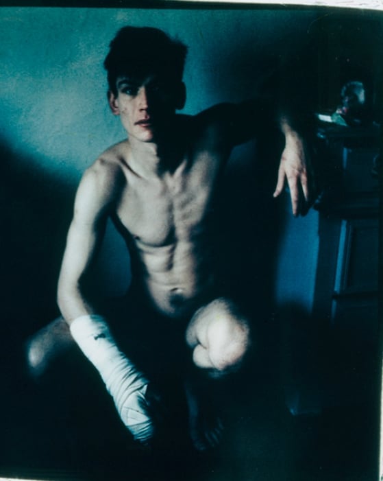 Self-Portrait With Broken Finger, Christmas 1984, 1984
