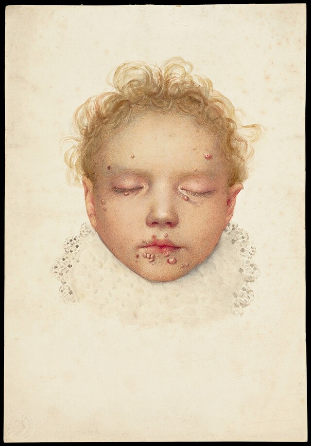 The head of a child with blisters and other lesions affectin