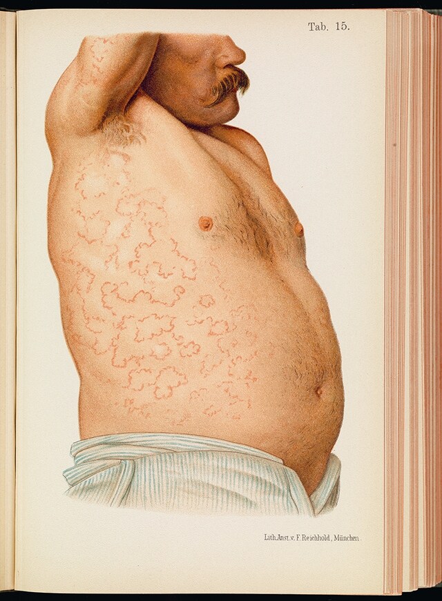 A male patient with erythema covering his abdomen and armpit
