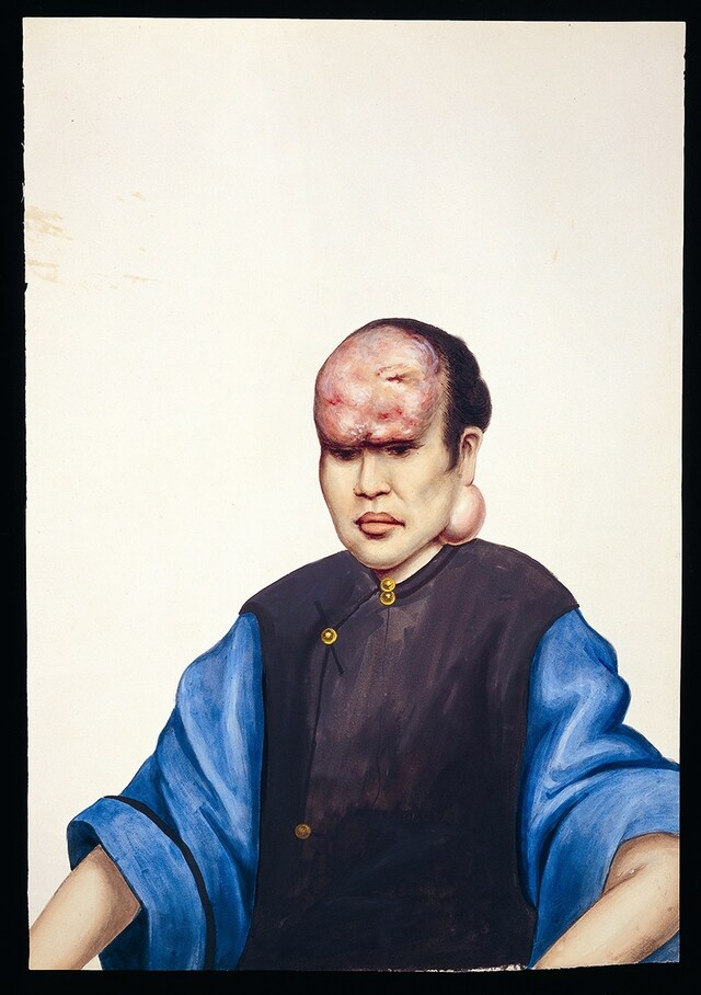 Forehead tumour in gouache by the 	painter, Lam Qua