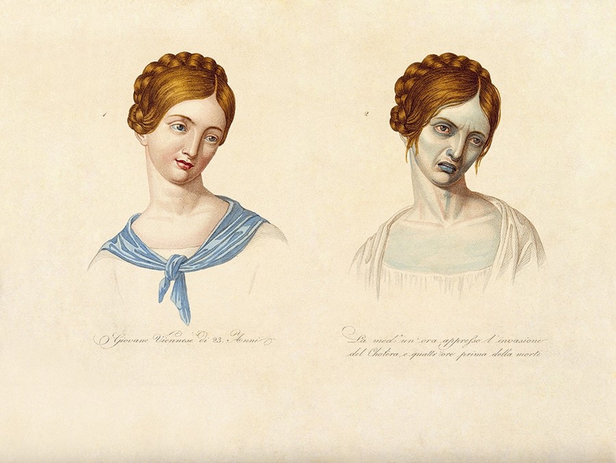 A Viennese woman depicted during the latter stages of choler