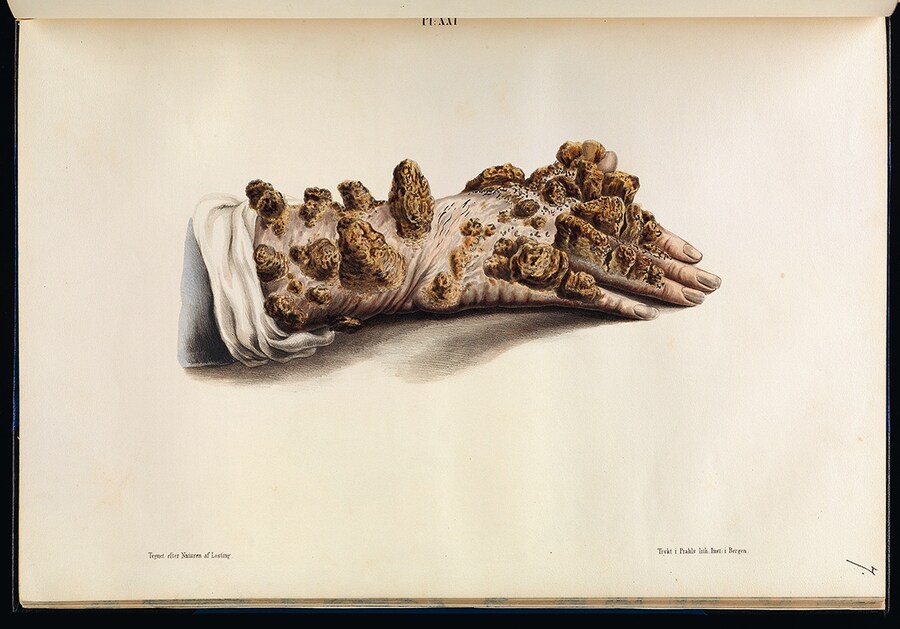 ‘Tubercular leprosy’ (or ichthyosis) of the hand